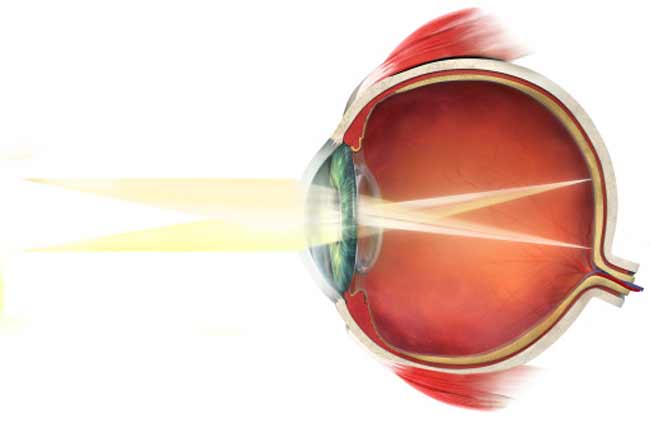 Retina