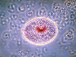 Scientists have identified a Gene that Stops Common Lung Cancer Spread