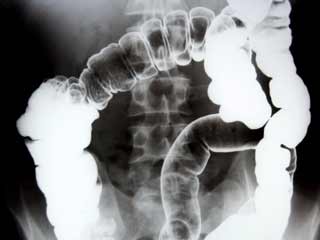 Points to Remember: Lower GI Series