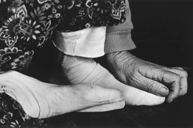 वेनस इन्सुफिसिएंसी (Venous insufficiency)