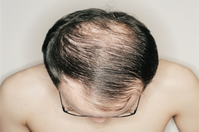 स्कैल्प पर पैचेज