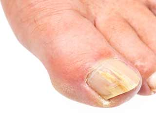 What are the Symptoms of Onycholysis