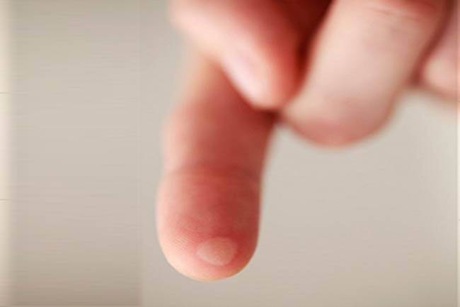 Skin Inflammation