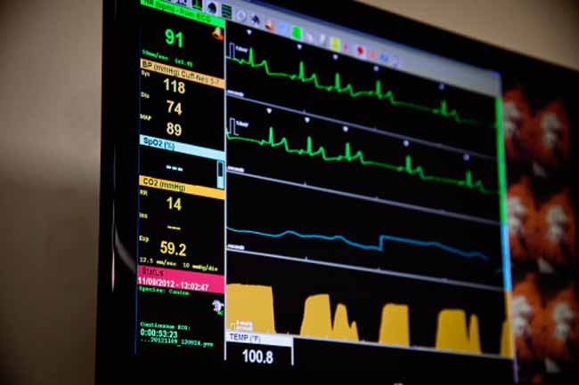Irregular Pulse