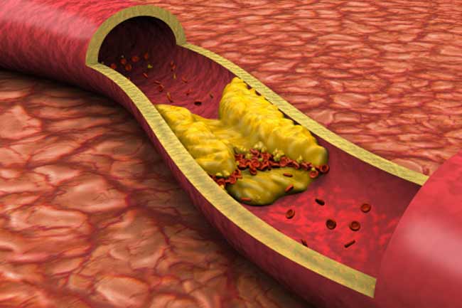 Cholesterol Levels