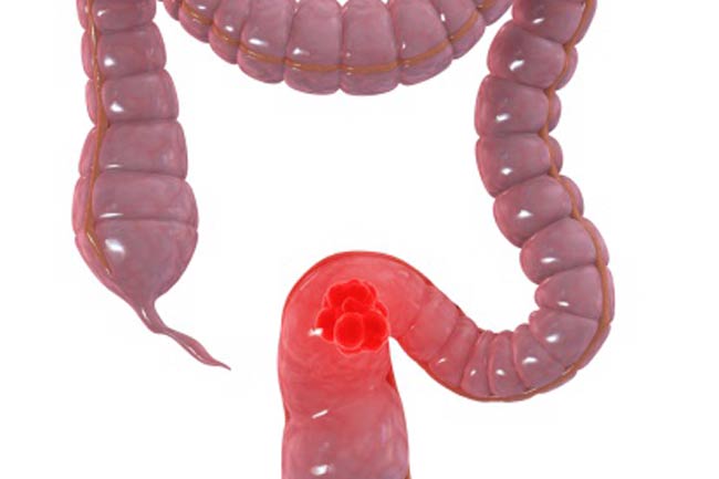 Colorectal Cancer