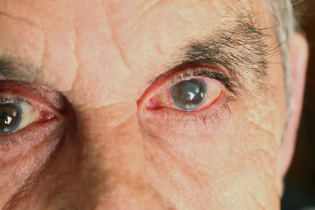 Glaucoma