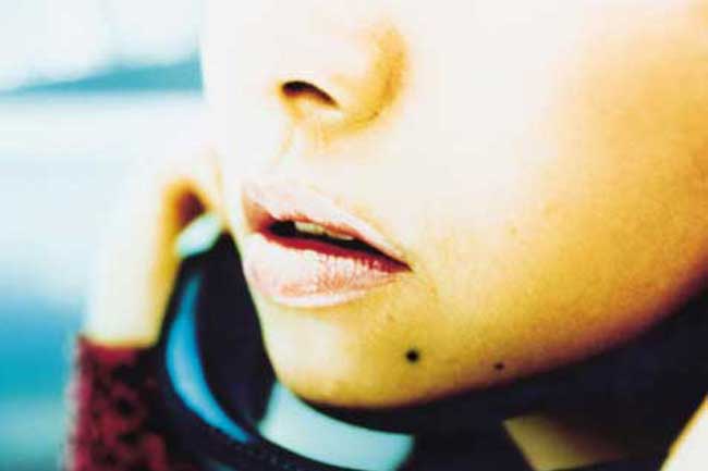 Mole on Chin