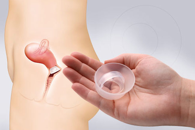 Cervical Cap