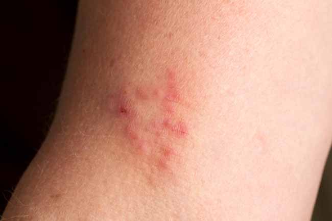 red bumps on legs that itch at night