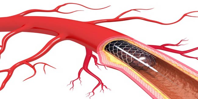 What To Expect Before A Stent Miscellaneous 