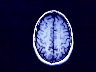 What is the prognosis of Acute Disseminated Encephalomyelitis?