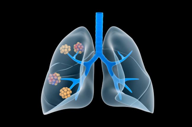 Chronic Bronchitis