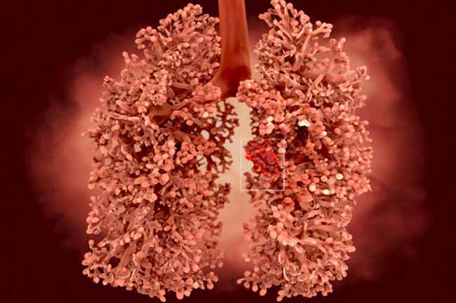 Lung Cancer