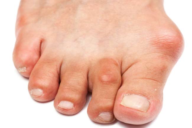गोखरू (Bunions)