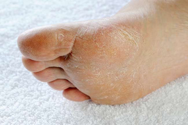 डायबिटिक फूट (Diabetic foot)