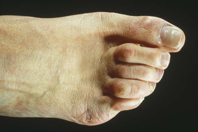 हैमर टो (Hammer toes)