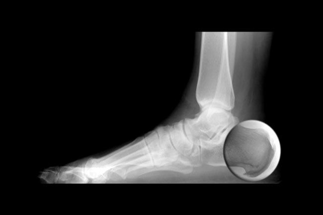 एड़ी में गांठ (Heel spurs)