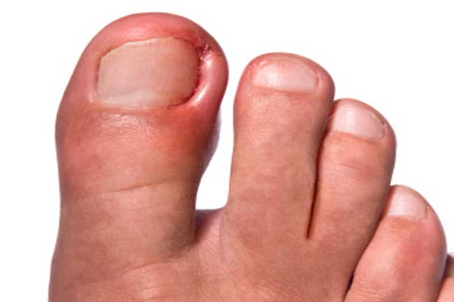 अंतर्वर्धित नाखून (Ingrown nails)