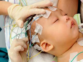 What is the treatment of Holoprosencephaly?