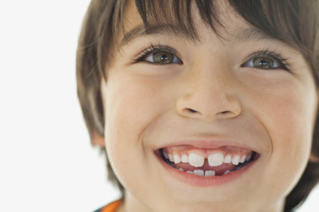 Fluoride Treatments for Kids