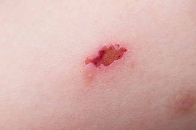 Eczema