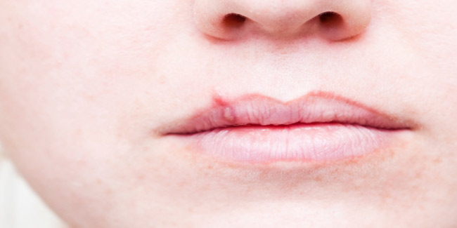 5 Disturbing Facts About Cold Sores Women Should Know Cold Sores And