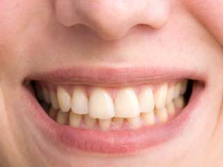 Tooth Discolouration after Trauma