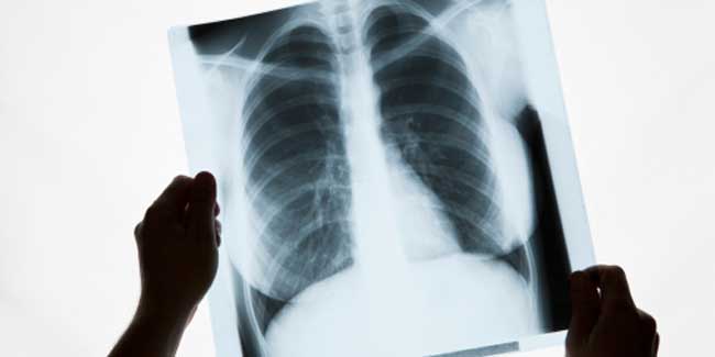 Risk factors for acute respiratory distress syndrome (ARDS)