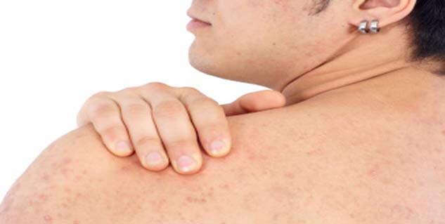 Lemon for Back Acne Treatment Lemon for Back Acne Treatment