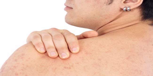 Effective natural remedies to clear up back acne