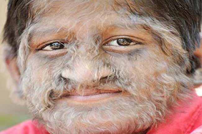 वेयरवुल्फ़ सिंड्रोम