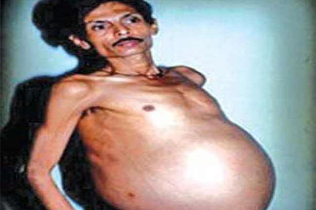 जब आदमी हुआ प्रेगनेंट