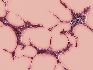 New study finds that breast cancer may fight other cancers too