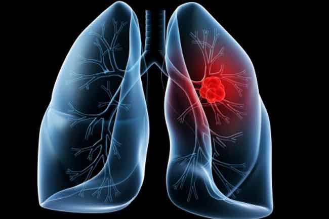 Ct Scans for Early Lung Cancer Detection