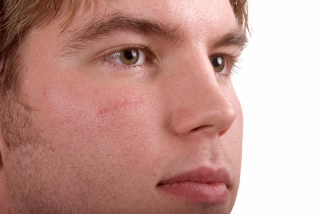 Rids Embarrassing Scars
