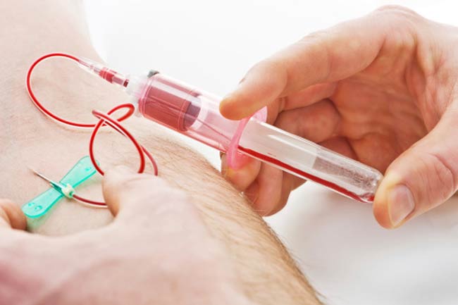 पीएसए टेस्ट (Prostate Specific Antigen)