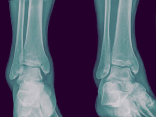 How is Osteoporosis related to Celiac Disease