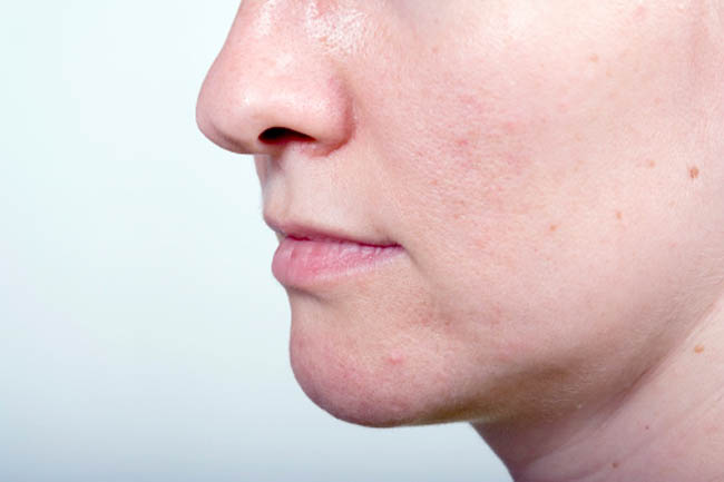 Skin with Open Pores