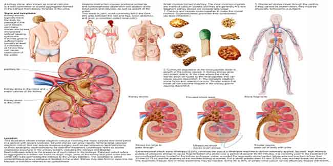 किडनी की पथरी के लिए शॉक वेव लीथोट्रिप्सी ट्रीटमेंट