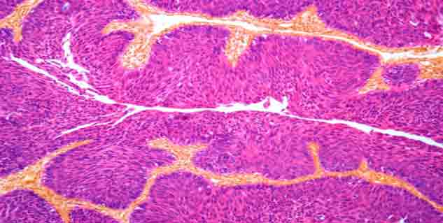 ब्लैडर कैंसर blader cancer in hindi