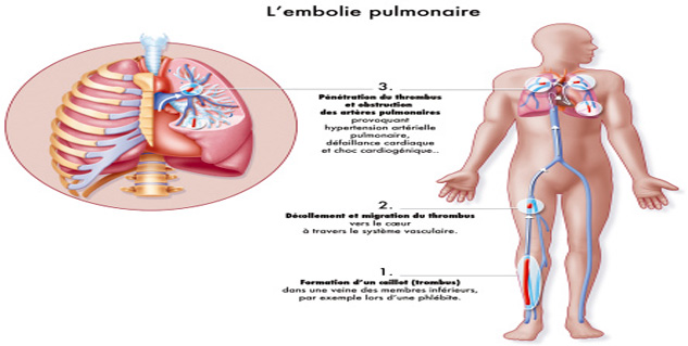 खून के थक्कों की रोकथाम Blood Clotting in Hindi