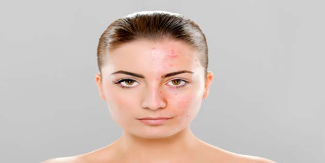 acne vulgaris