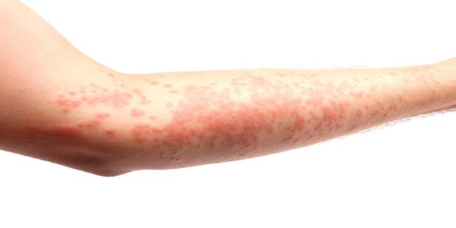 Can Allergies Cause Skin Problems