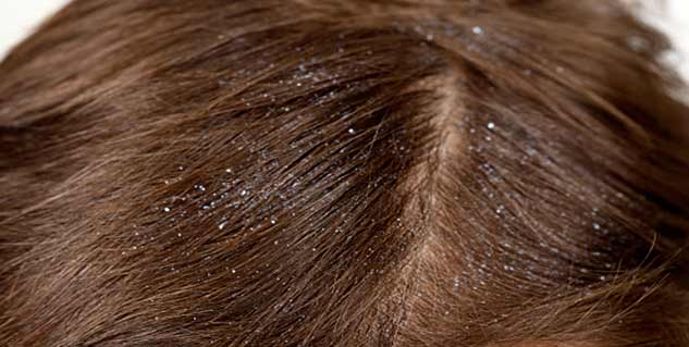 Ayurveda for dandruff Ayurveda for dandruff