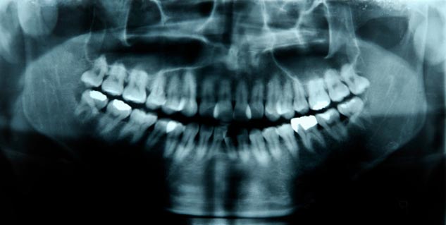 बुद्धि दांत के फायदे Wisdom tooth in Hindi