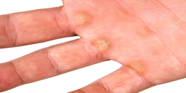 how-to-cure-corns-and-calluses-fashion-beauty