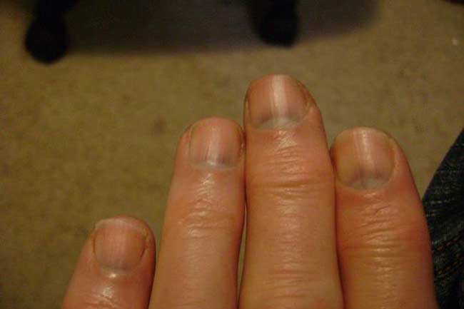 Causes of Dark Colored Nail Beds - wide 6