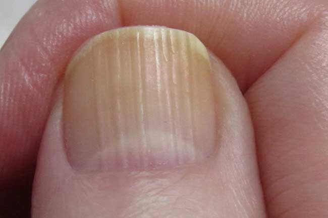 what-causes-ridges-in-your-fingernails-artofit