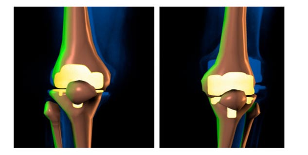 ज्वाइंट रिप्लेसमेंट joint replacement in hindi